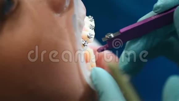 修复牙齿上的裂缝视频的预览图