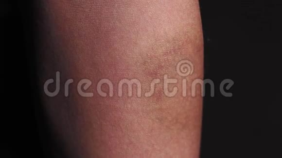 在黑色背景上特写的男人手臂上的擦伤瘀伤休克人体皮肤宏观选择性聚焦视频的预览图