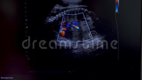 妊娠晚期超声检查视频的预览图