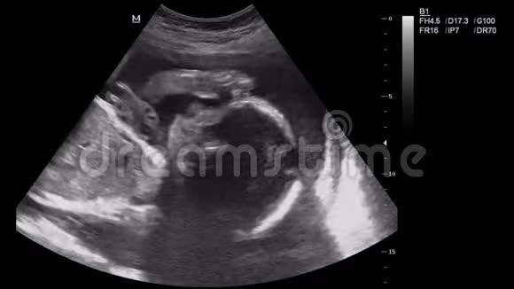 超声显示的人胚胎视频的预览图