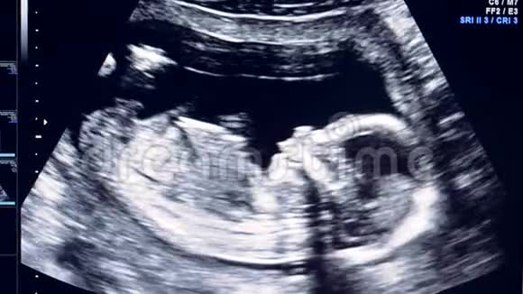 人体胚胎在超声显示仪上轻微移动头部视频的预览图