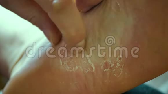 脚上有问题区域的皮肤干愈伤组织特写治疗视频的预览图