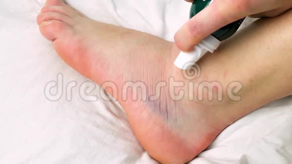 女人正在用弹性绷带在扭伤的脚踝上涂上凝胶扭伤的脚踝有白色背景的瘀伤视频的预览图