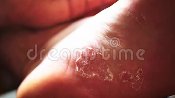 脚上有问题区域的皮肤干愈伤组织特写治疗视频的预览图