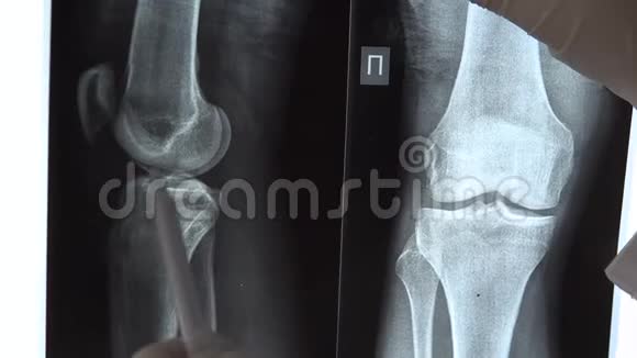医生检查膝关节x光检查结果医生检查了x射线的图像并显示视频的预览图