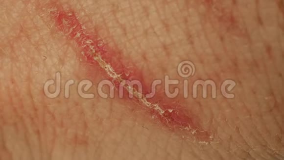 刮痕干燥的伤口特写愈合擦伤与地壳伤害手上皮肤刺激发红身体视频的预览图