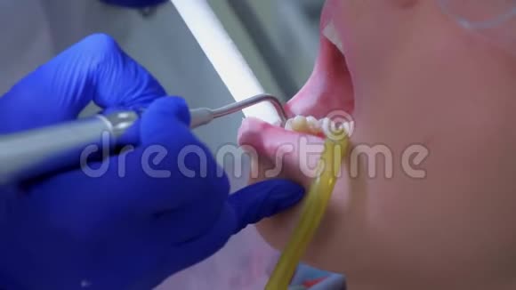 牙科保健师用水对牙齿进行超声波清洗特写视频的预览图