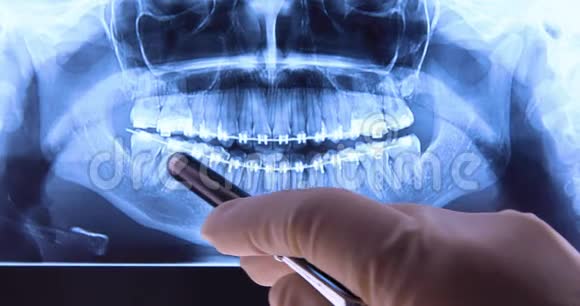 口腔医生用牙套分析牙片视频的预览图