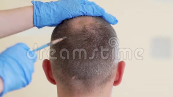 美容或头发移植美容医生在人头部注射头发或防止头发生长视频的预览图