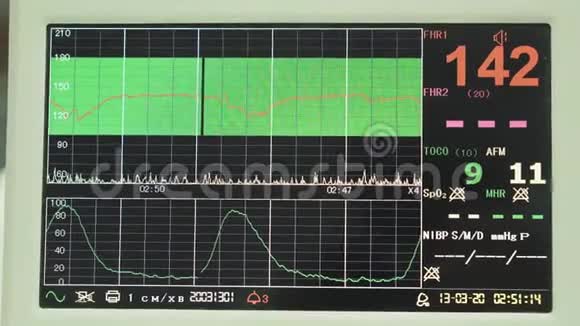 心电图监测心电图胎儿在子宫内心跳测量过程中心电图显示视频的预览图