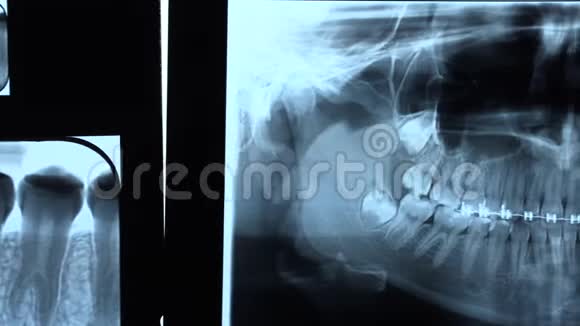 牙科诊所带牙套的人颌骨全景X线片视频的预览图
