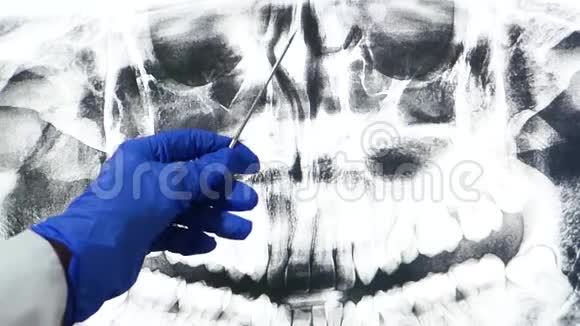 医生在大屏幕上显示x光检查鼻腔现代医学和技术视频的预览图