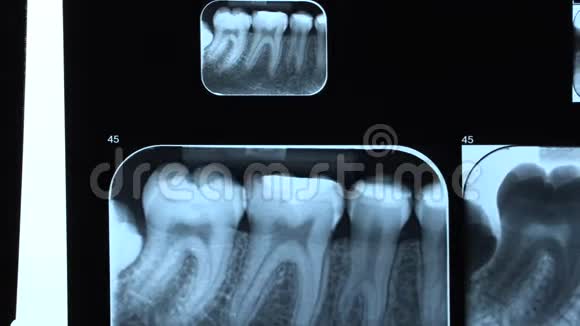 牙科诊所各种大小的牙科X光视频的预览图