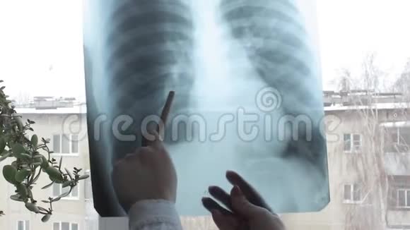 病人肺部肺炎s图像视频的预览图