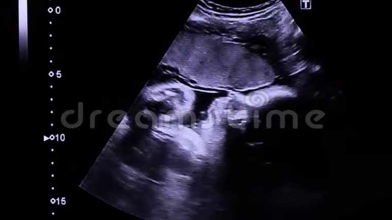 婴儿心跳和小手移动的面部超声图像36周9个月怀孕视频的预览图