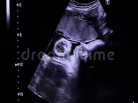 婴儿心跳和小手移动的面部超声图像36周9个月怀孕视频的预览图