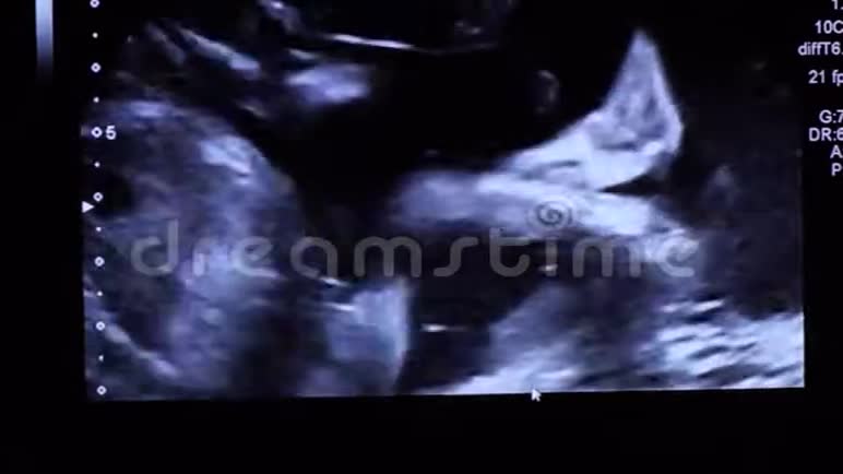 2d半超声检查中20周龄胎儿小腿脚运动视频的预览图