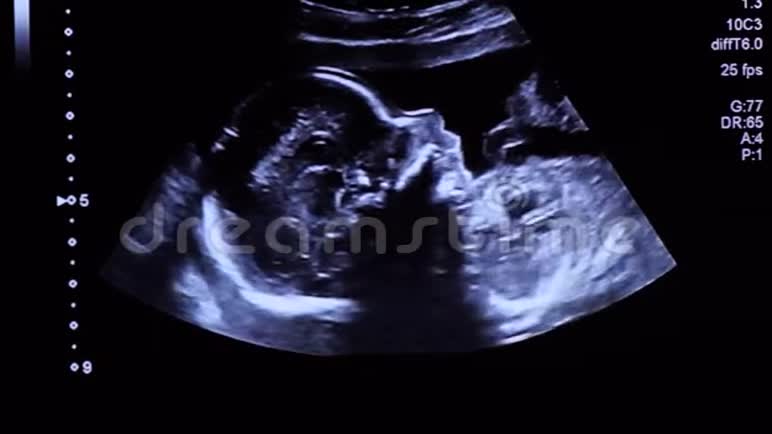 胎儿中期超声检查中20周龄婴儿面部及胸部轮廓视频的预览图