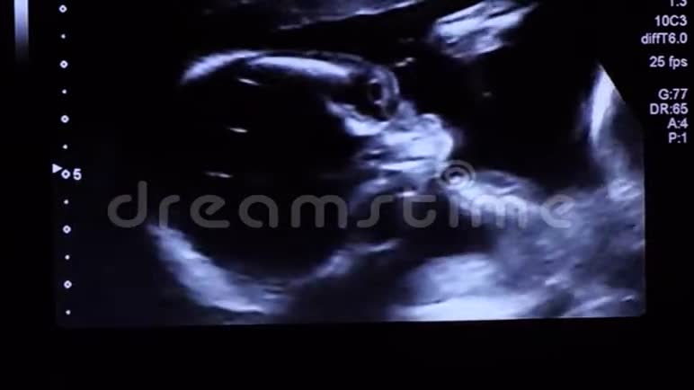 20周龄婴儿胎儿面部超声检查时直视屏幕视频的预览图
