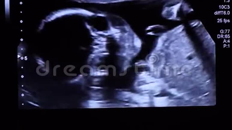 20周龄婴儿胎儿面部超声检查时直视屏幕视频的预览图