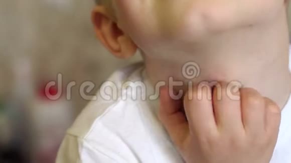 小男孩脖子上过敏部位特写过敏反应视频的预览图