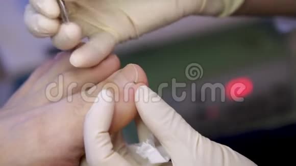 神学足科医生用镊子病人的大脚趾特写视频的预览图