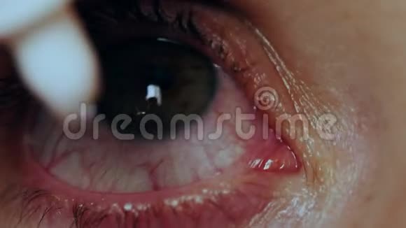 妇女滴剂治疗结膜炎视频的预览图