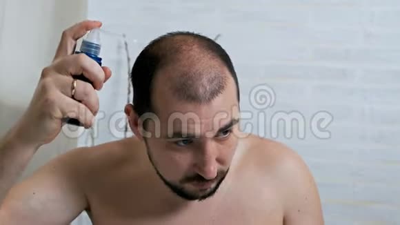 打击男性脱发头部注射治疗男性模式秃顶早期脱发一个男人用视频的预览图