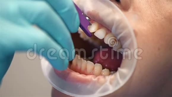 牙医安装Braces视频的预览图