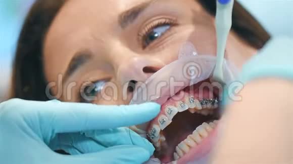 牙医在Braces上安装电弧视频的预览图