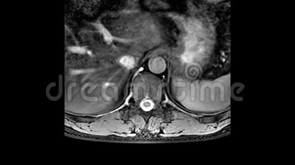 胸部MRI脊柱突出和疝的检测视频的预览图