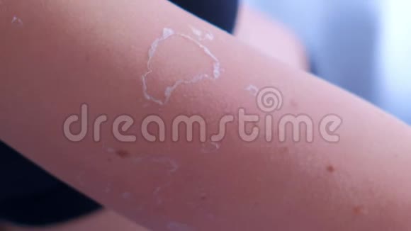 女人剥落去除剥落烧伤后的皮肤暴露太多的阳光视频的预览图