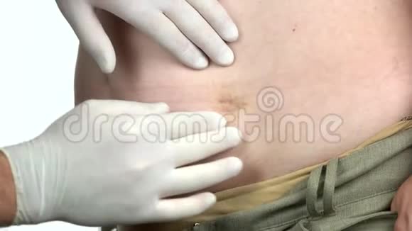 带手套的医生检查一个人腹部的斑点视频的预览图
