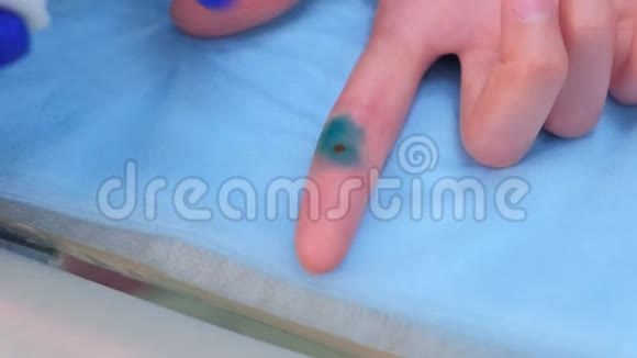 外科医生在病人手指上取出的疣上涂上绿色防腐剂视频的预览图