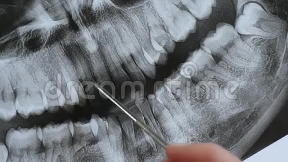 颌骨特写的全景断层扫描正畸医生分析咬合进行牙科治疗视频的预览图