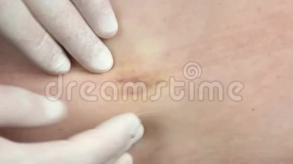 医生用手套检查病人的皮肤视频的预览图