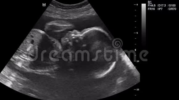 孕妇6个月的超声检查视频的预览图