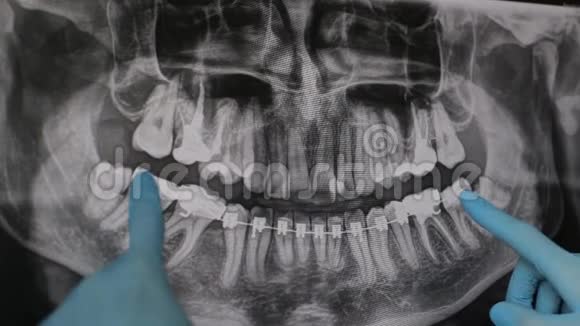 医生在监视器上显示了颌骨x光的治疗方案视频的预览图