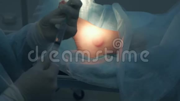外科医生正在为手术前的局部麻醉输入注射器药物视频的预览图