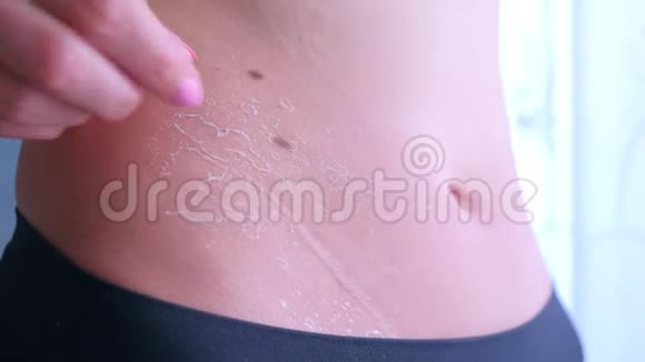 女人在暴露在太多的阳光下后剥落了腹部烧焦的皮肤视频的预览图
