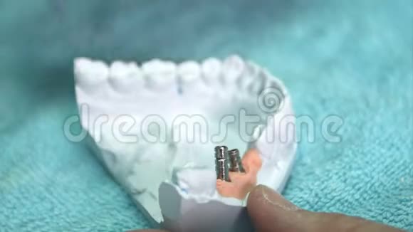 牙科用种植体修复体模型视频的预览图