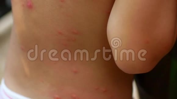 蚊子和其他昆虫的叮咬在孩子的背上视频的预览图