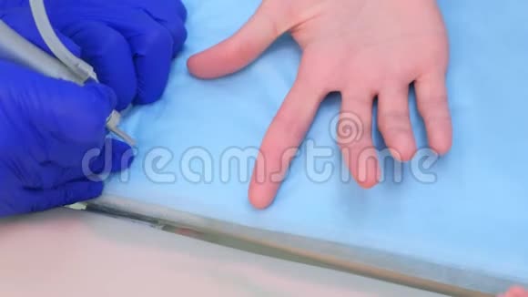 外科医生用激光清除病人手指上的疣双手特写视频的预览图
