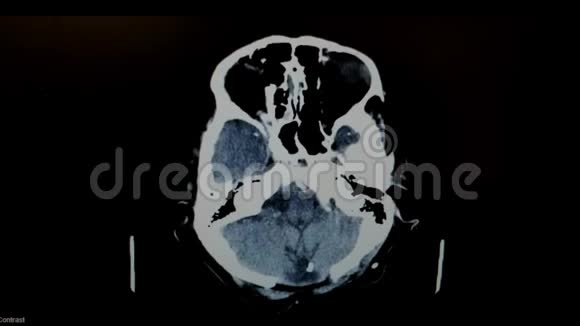 带囊虫病的脑部CT影像猪肉绦虫幼虫视频的预览图