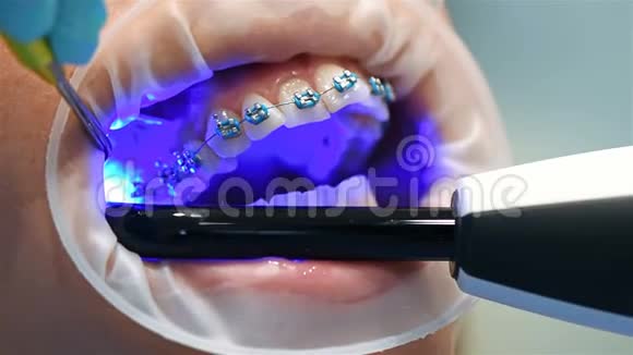 牙医修理Braces视频的预览图