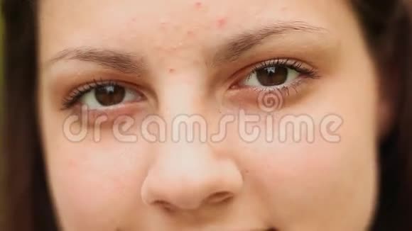 少女脸上带痘特写脸上的痘痘棕色眼睛视频的预览图
