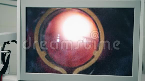 在屏幕上显示眼睛上的手术程序视频的预览图