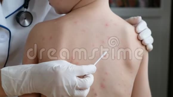 医生在婴儿的皮肤上涂奶油以预防水痘及皮疹视频的预览图