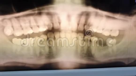 显示闪烁效果的中年男子全景牙科X射线照片视频的预览图