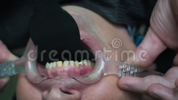 病人在手术中牙齿视频的预览图